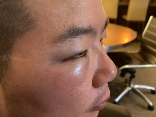 華裔家庭日前在法拉盛遭非洲裔侮辱,、攻擊,、性騷擾,、砸車,華裔父親臉部被揍多拳,右眼瘀青腫漲嚴(yán)重,。(來(lái)源:美國(guó)《世界日?qǐng)?bào)》記者賴蕙榆 攝 ) 華裔家庭日前在法拉盛遭非洲裔侮辱,、攻擊、性騷擾,、砸車,,華裔父親臉部被揍多拳,右眼瘀青腫漲嚴(yán)重。(來(lái)源:美國(guó)《世界日?qǐng)?bào)》記者賴蕙榆 攝 )