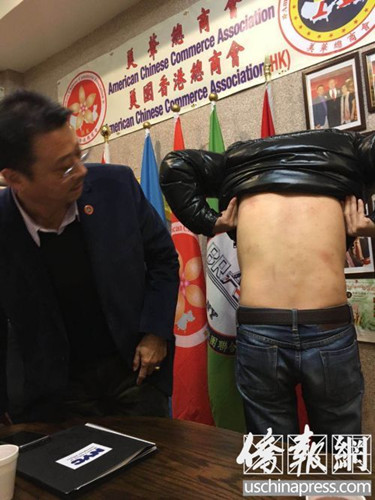 受害華青之一向布碌侖亞總會(huì)會(huì)長陳善莊求助,,展示被打慘狀(僑報(bào)記者