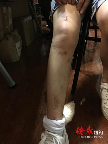 嚴(yán)重骨折的陳女士至今未從右腿的傷痛中康復(fù)過來。(美國《僑報(bào)》/崔國萁