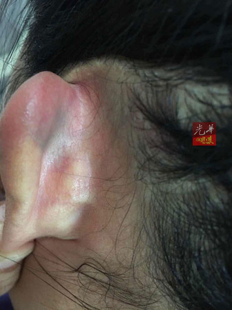 林偉勸妻子的后腦遭匪徒持刀柄敲傷,耳后出現(xiàn)淤血,。(馬來西亞《光華日報》)