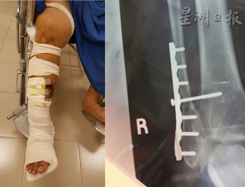 中國僑網(wǎng)事主的右腳骨斷,,必須通過手術(shù)置入螺釘及鋼板固定骨折處,,留院治療超過1個月。(馬來西亞《星洲日報》)