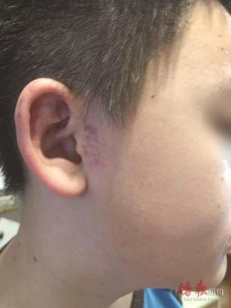 中國(guó)僑網(wǎng)華裔學(xué)生被打傷。(紐約《僑報(bào)》)